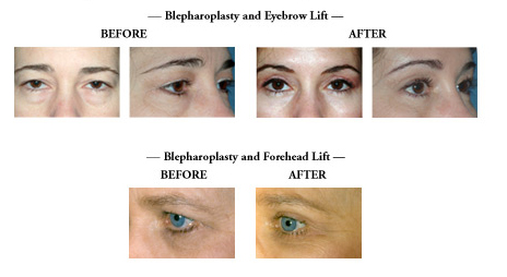 Memphis Blepharoplasty | Memphis Tennessee Plastic Surgery - The ...