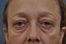 before blepharoplasty front view female patient case 1652