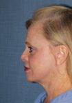 After Deep Plane Facelift side Memphis, TN | The Langsdon Clinic