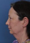 Before Deep Plane Facelift side Memphis, TN | The Langsdon Clinic