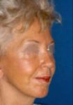 After Deep Plane Facelift angle Memphis, TN | The Langsdon Clinic